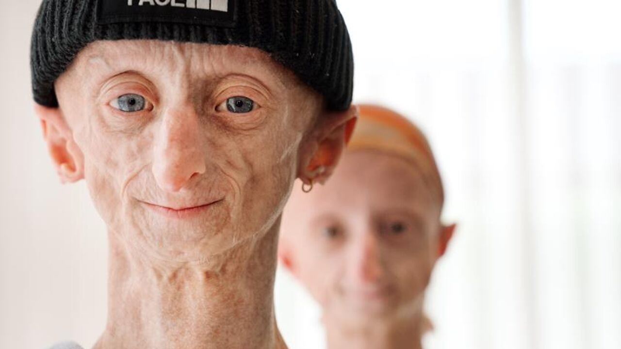 Michiel Vandeweert (28) uit Diepenbeek met verouderingsziekte progeria overleden