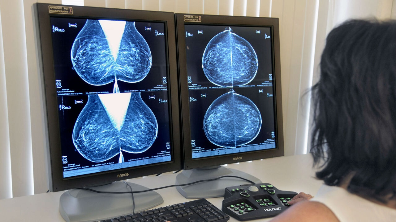 4 Vlaamse borstklinieken testen AI-systeem dat voorspelt welke kankerbehandeling meest geschikt is voor welke patiënt