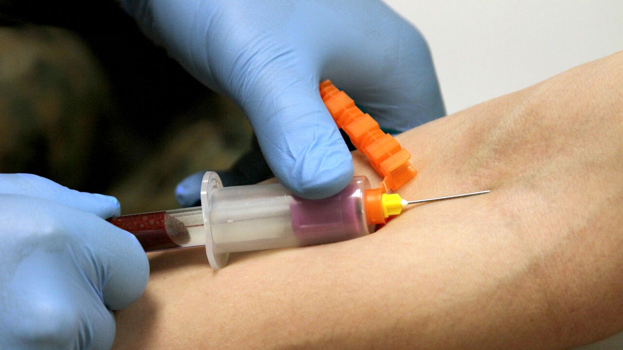 Bloedtest zou aantal vruchtwaterpuncties kunnen terugdringen en veel meer ernstige syndromen opsporen