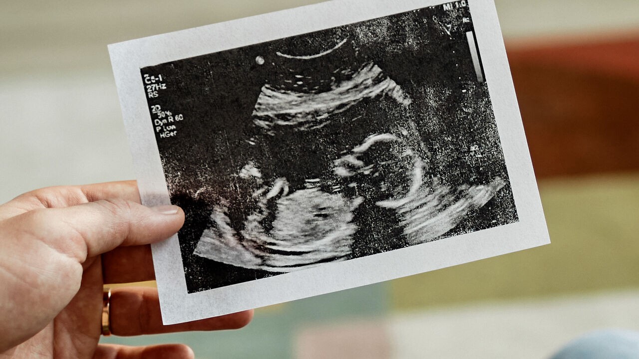 Al zeker 93 spermadonoren vaker gebruikt dan toegelaten in België, veel meer dan tot nu toe bekend