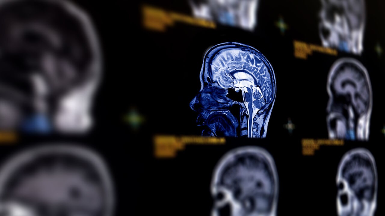 "Hoge bloeddruk is belangrijkste factor": hoe herken je een hersenbloeding? En hoe vaak komt het voor?