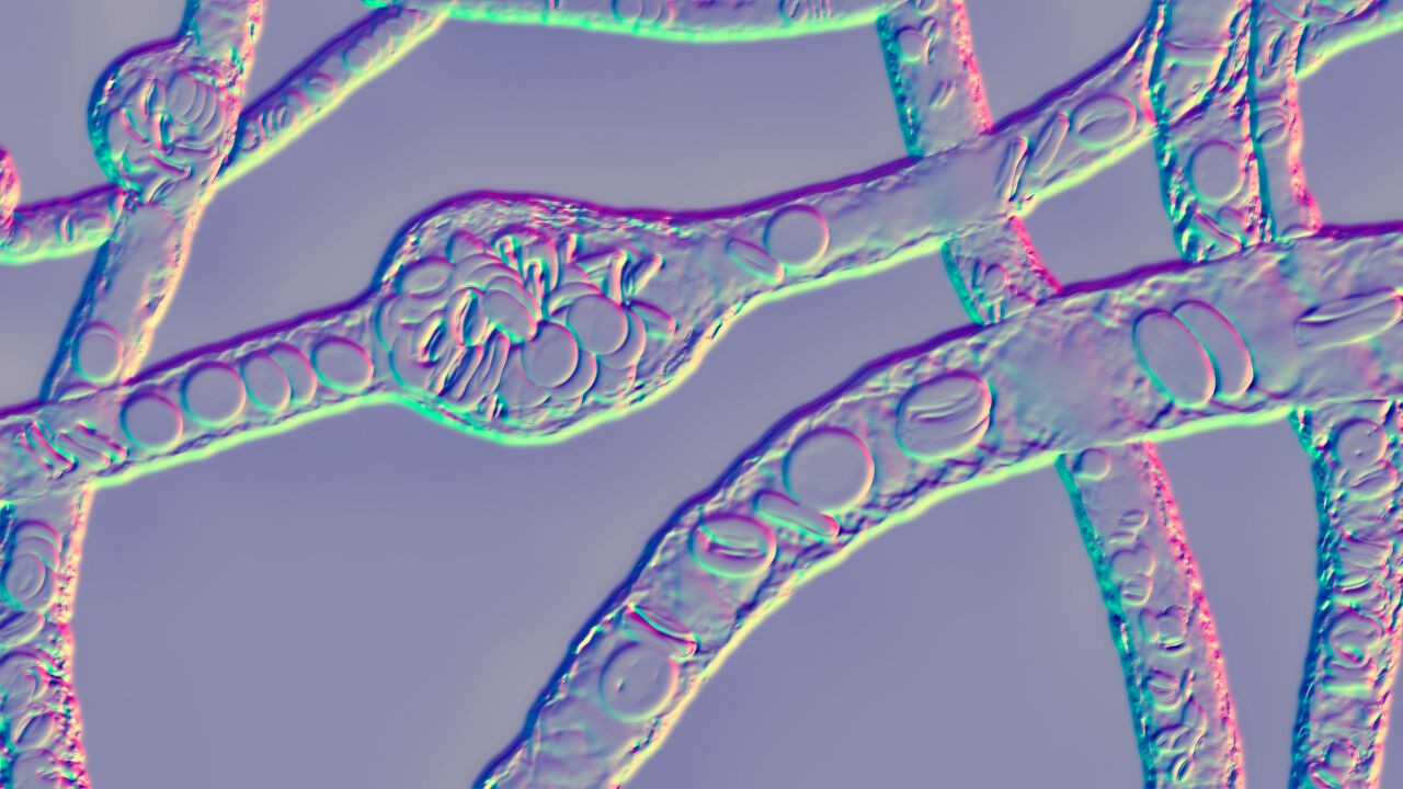 Uitstulping van bloedvat die fataal kan aflopen: wat is hersenaneurysma, waaraan man van Belle Perez overleed?
