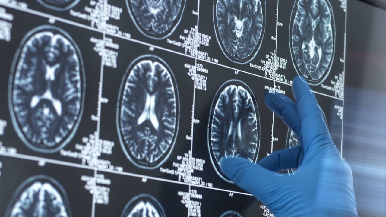 Vlaamse universiteiten bundelen krachten om sneller alzheimer op te sporen via bloedtesten