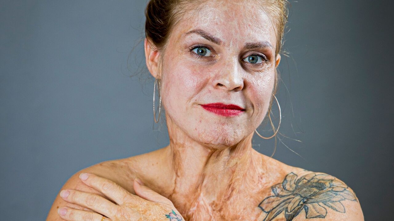 "Goed dat slachtoffers niet weten wat er op hen afkomt": ook Evi raakte op haar 16e van hals tot hielen verbrand