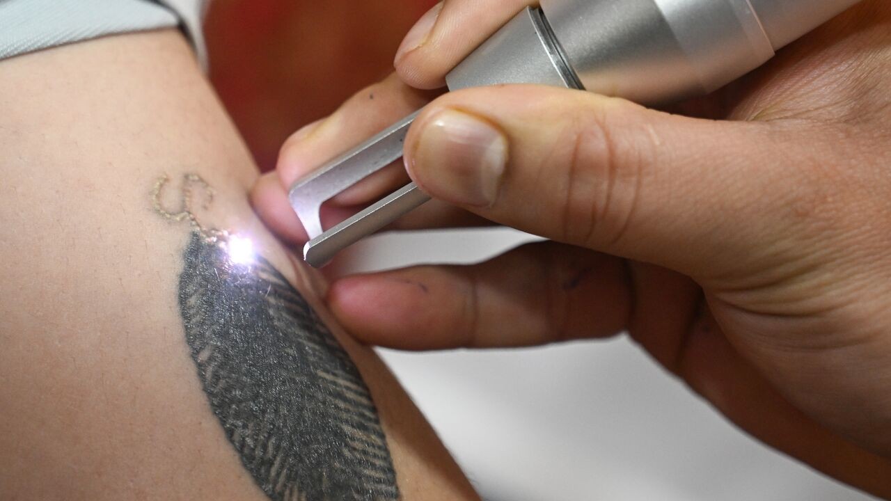 Dermatoloog waarschuwt voor risico's bij tattooverwijdering: "Ga naar gespecialiseerde arts, niet naar tattoostudio"
