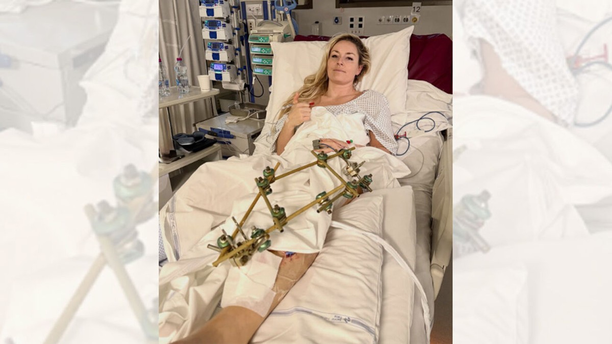 Drie operaties later toont Lindsey Vonn eerste foto van verbrijzeld been: "Succes heeft nu een andere betekenis"