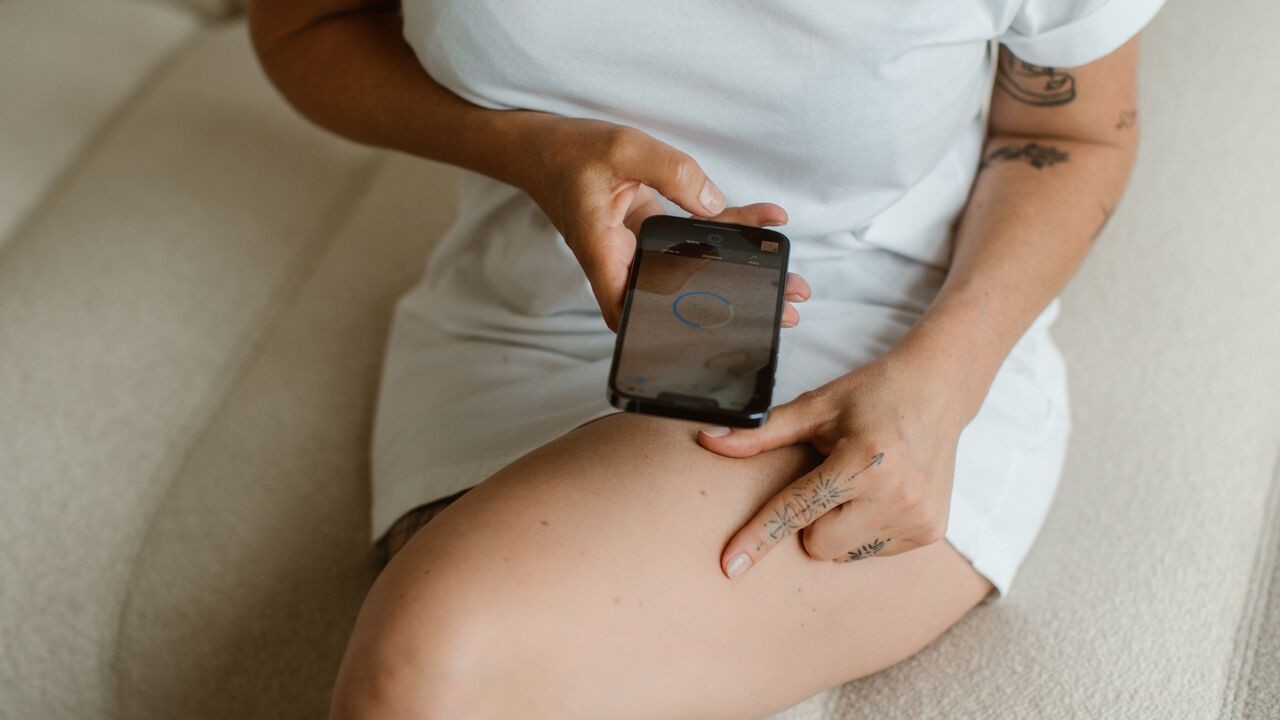 Huid-app SkinVision mist 1 op 4 kankers en geeft vals alarm bij 1 op 8 vlekjes, blijkt uit studie UGent