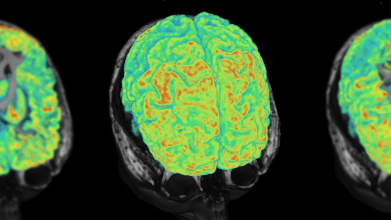 20 keer scherper: nieuwe hersenscanner spoort dementie en parkinson op vóór eerste symptomen